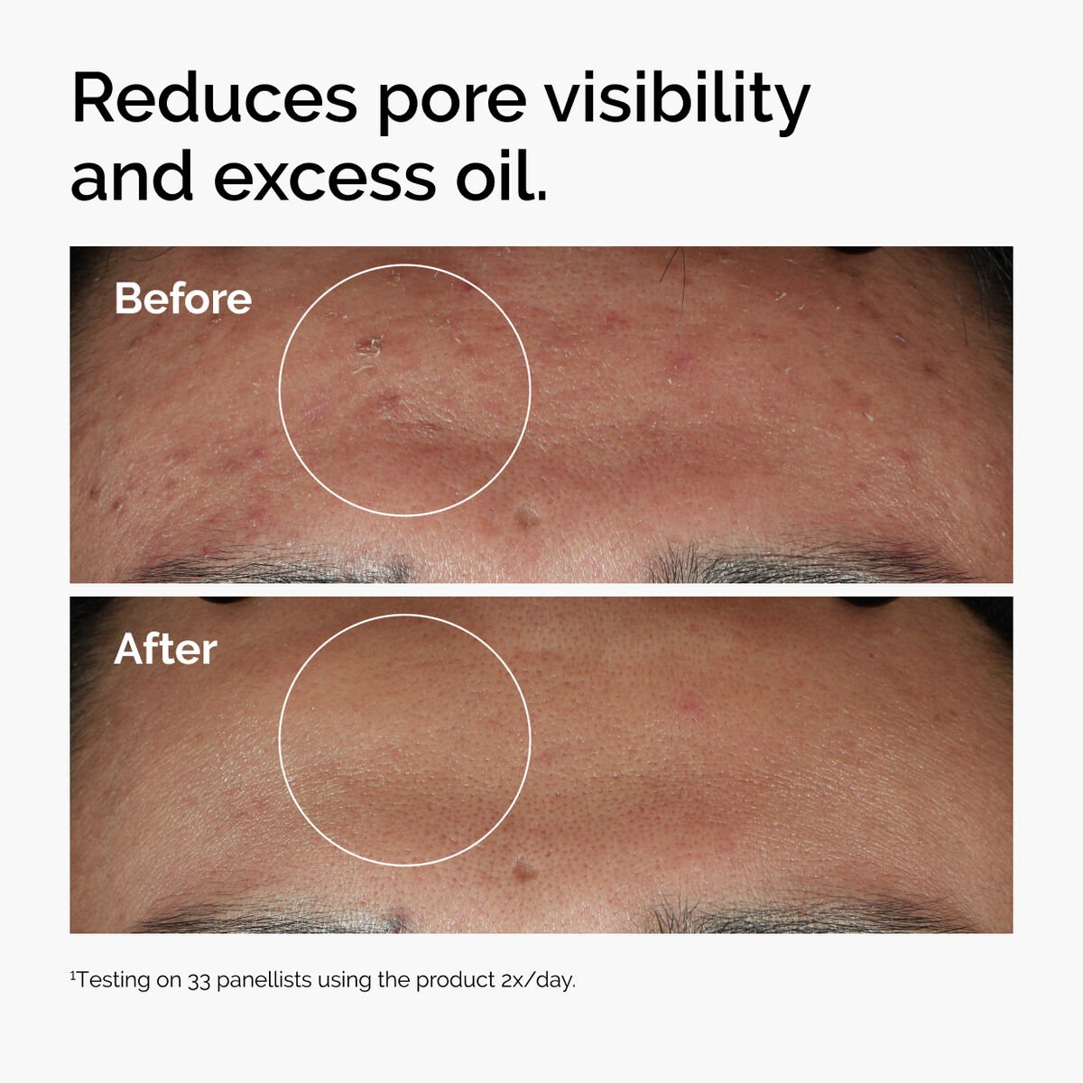 The Ordinary Niacinamide 10% & Zinc 1% Water-Based Face Serum for Blemish-Prone, Oily Skin β Pores & Oil Control (30ml)